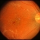 Possible CMV Retinitis with Frosted Branch Angiitis